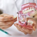 Why Choose an Implant Bridge Over Dentures? Stability, Comfort, and Confidence Compared
