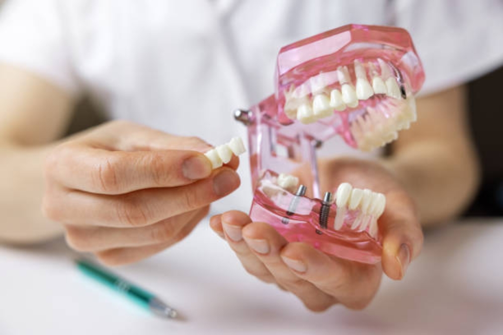 Why Choose an Implant Bridge Over Dentures? Stability, Comfort, and Confidence Compared