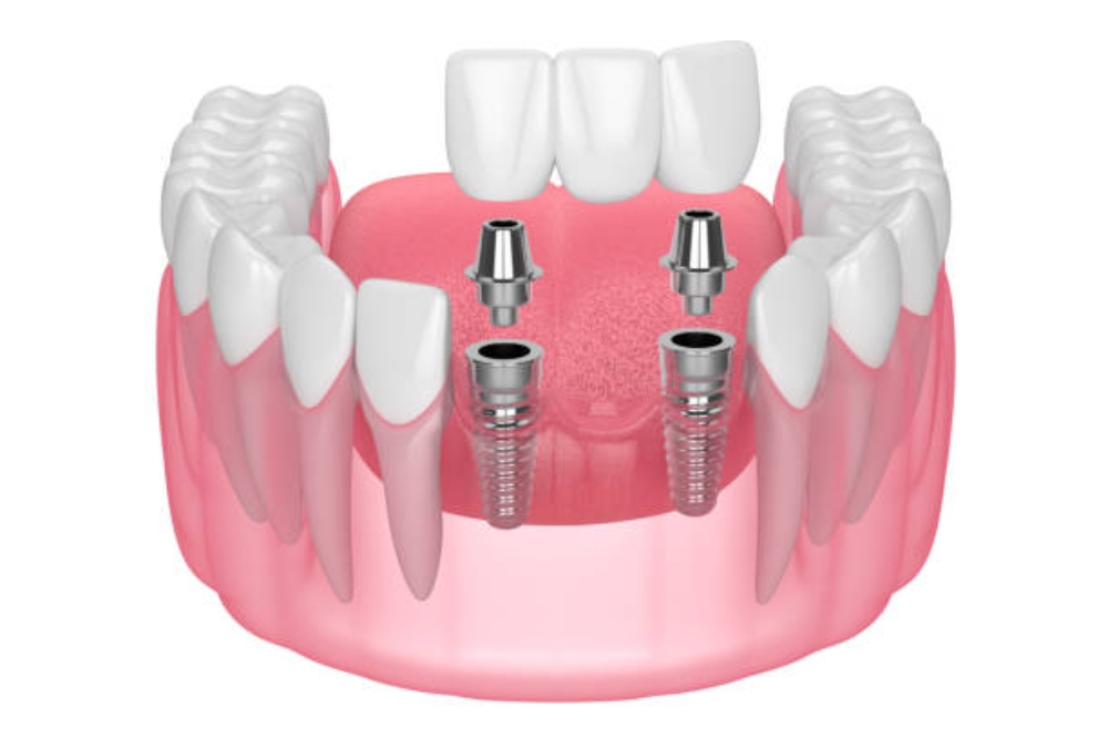 Are Same-Day Implant Bridges Possible? When Immediate Solutions Are an Option