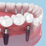 Implant Bridge Procedure Step-by-Step: What to Expect