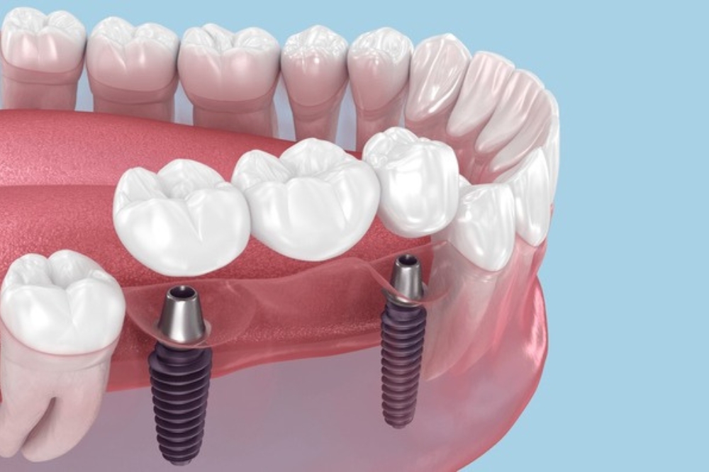 Implant Bridge Procedure Step-by-Step: What to Expect
