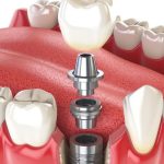 Missing Teeth? Here’s Why Dental Implants Are the Best Solution