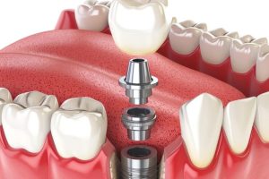 Missing Teeth? Here’s Why Dental Implants Are the Best Solution