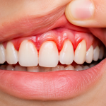 Bleeding Gums? It Could Be a Sign of Gum Disease