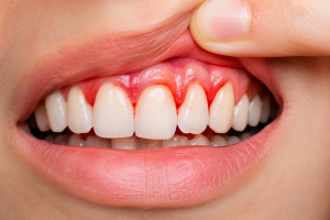 Bleeding Gums? It Could Be a Sign of Gum Disease